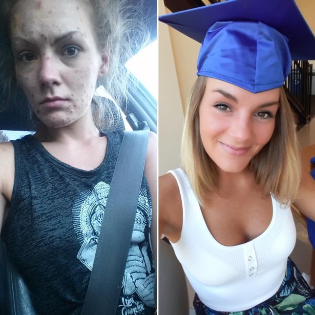 Woman, 25, shares incredible before and after photos following heroin ...